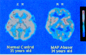 正常者と覚醒剤乱用者の脳血流分布を示す写真